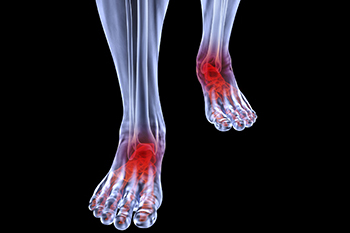 arthritic foot and ankle care treatment in the Monmouth County, NJ: Freehold (Manalapan, Carrs Corner, Millstone, Holmeson, Howell, Colts Neck, Marlboro, Spring Valley, Holmdel, Wall) area