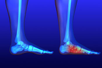 Flat feet and Fallen Arches treatment in the Monmouth County, NJ: Freehold (Manalapan, Carrs Corner, Millstone, Holmeson, Howell, Colts Neck, Marlboro, Spring Valley, Holmdel, Wall) area