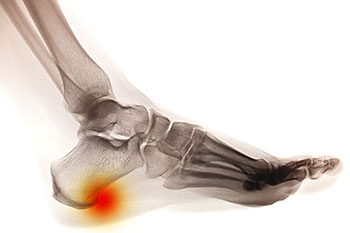 Heel spurs treatment in the Monmouth County, NJ: Freehold (Manalapan, Carrs Corner, Millstone, Holmeson, Howell, Colts Neck, Marlboro, Spring Valley, Holmdel, Wall) area