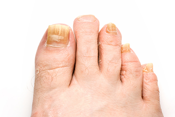 fungus toenails treatment in the Monmouth County, NJ: Freehold (Manalapan, Carrs Corner, Millstone, Holmeson, Howell, Colts Neck, Marlboro, Spring Valley, Holmdel, Wall) area