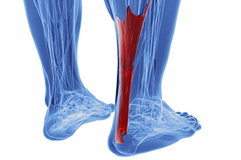 achilles tendon treatment in the Monmouth County, NJ: Freehold (Manalapan, Carrs Corner, Millstone, Holmeson, Howell, Colts Neck, Marlboro, Spring Valley, Holmdel, Wall) area