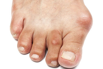 bunions treatment in the Monmouth County, NJ: Freehold (Manalapan, Carrs Corner, Millstone, Holmeson, Howell, Colts Neck, Marlboro, Spring Valley, Holmdel, Wall) area