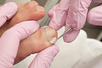 Ingrown toenails treatment in the Monmouth County, NJ: Freehold (Manalapan, Carrs Corner, Millstone, Holmeson, Howell, Colts Neck, Marlboro, Spring Valley, Holmdel, Wall) area