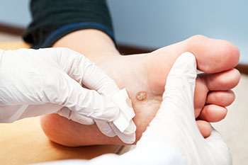 Plantar warts treatment in the Monmouth County, NJ: Freehold (Manalapan, Carrs Corner, Millstone, Holmeson, Howell, Colts Neck, Marlboro, Spring Valley, Holmdel, Wall) area